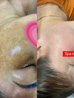 Điều Trị Nám Chuyên Sâu