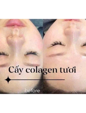 Cấy Collagen Tươi