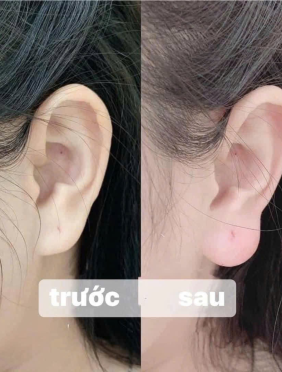 Tiêm Tai