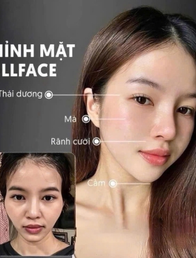 FullFace ( thái dương, má hóp, rãnh cười, cằm)